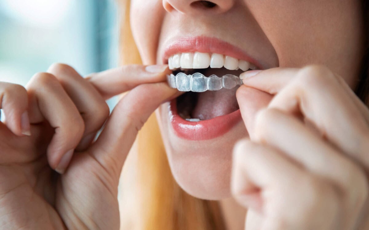 Clear Aligners for Adults