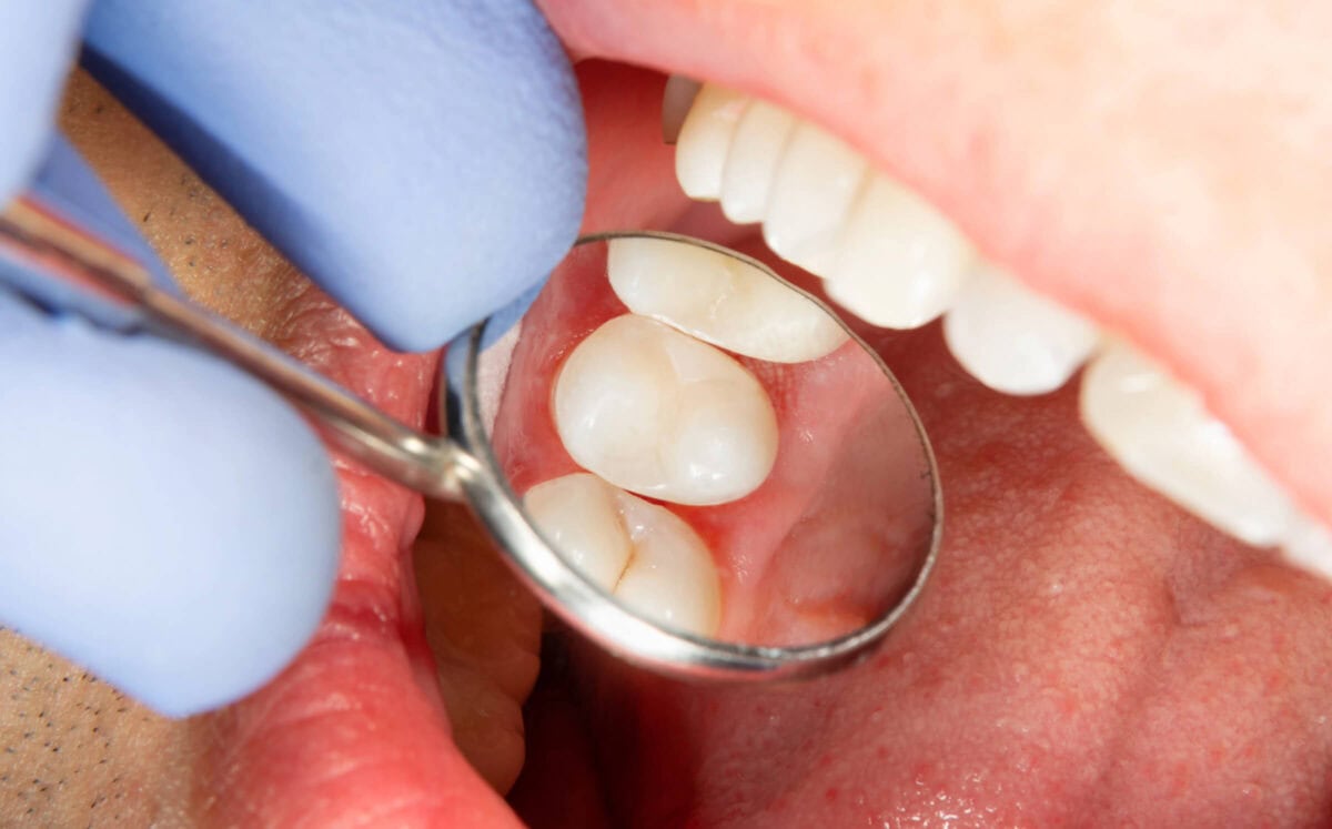 Sealants