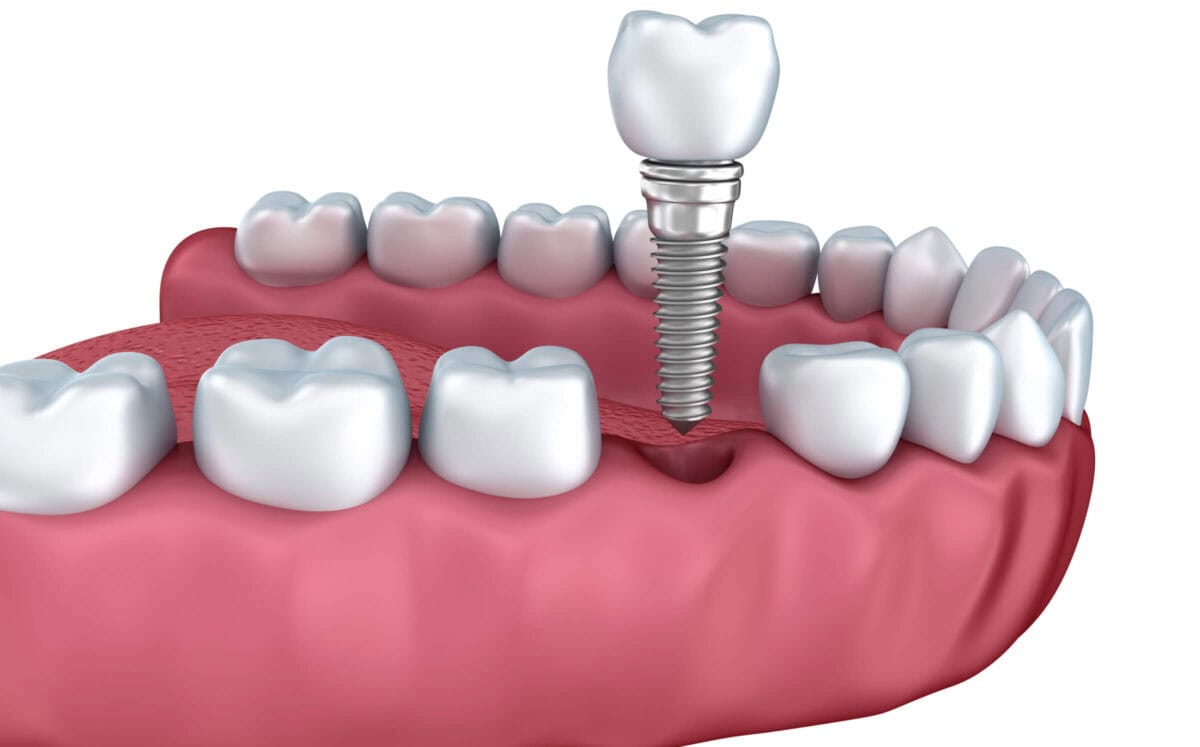 Dental Implants