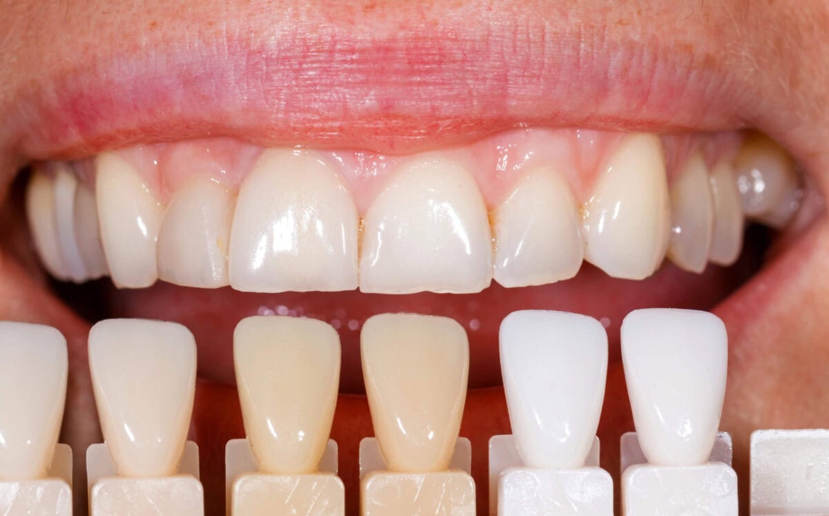 Veneers