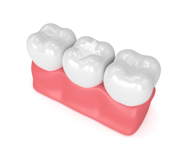 Fillings